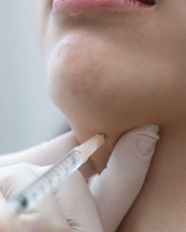 What is Microneedling? Exploring the Harmony of Skincare
