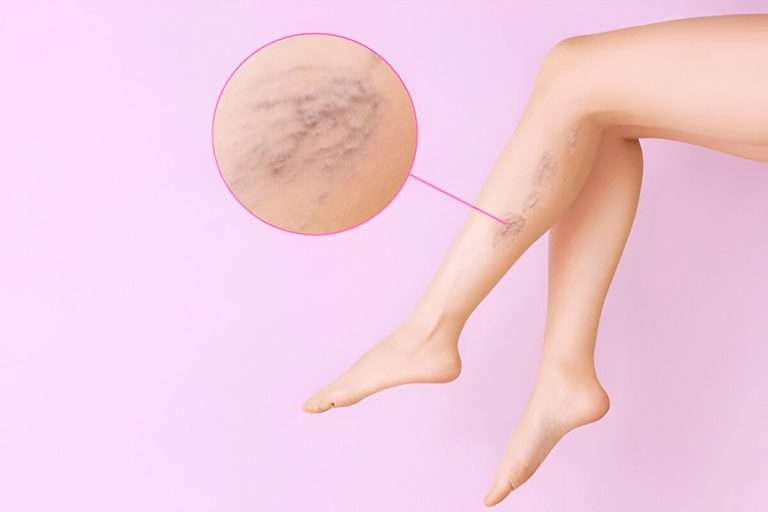 spider vein treatment near you in Oklahoma
