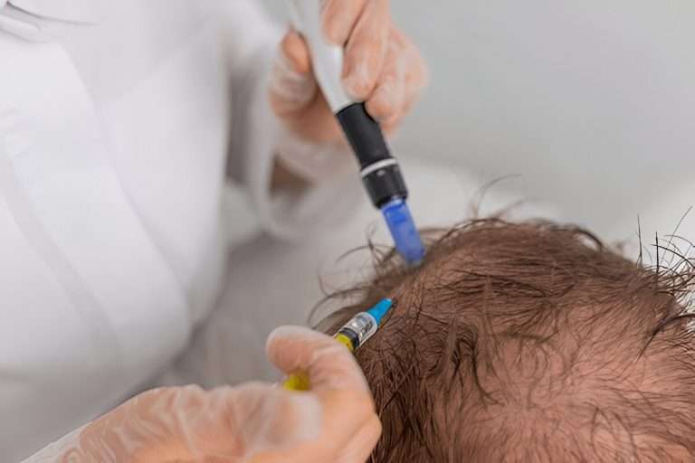 PRP microneedling for hair loss