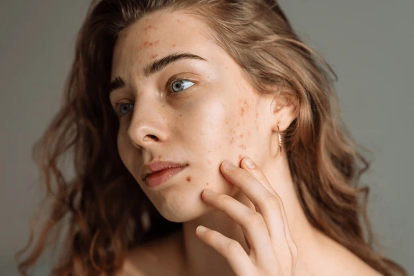 stress and skin problems