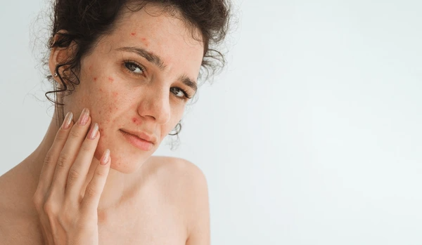 hormones and skin
