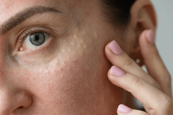 microneedling aftercare