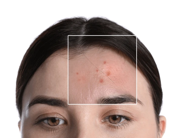 large pores treatment